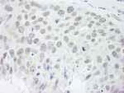 Immunohistochemistry-Paraffin: FOX2 Antibody [NB110-40588] - FFPE section of human breast carcinoma.  Affinity purified rabbit anti-RBM9 used at a dilution of 1:250.