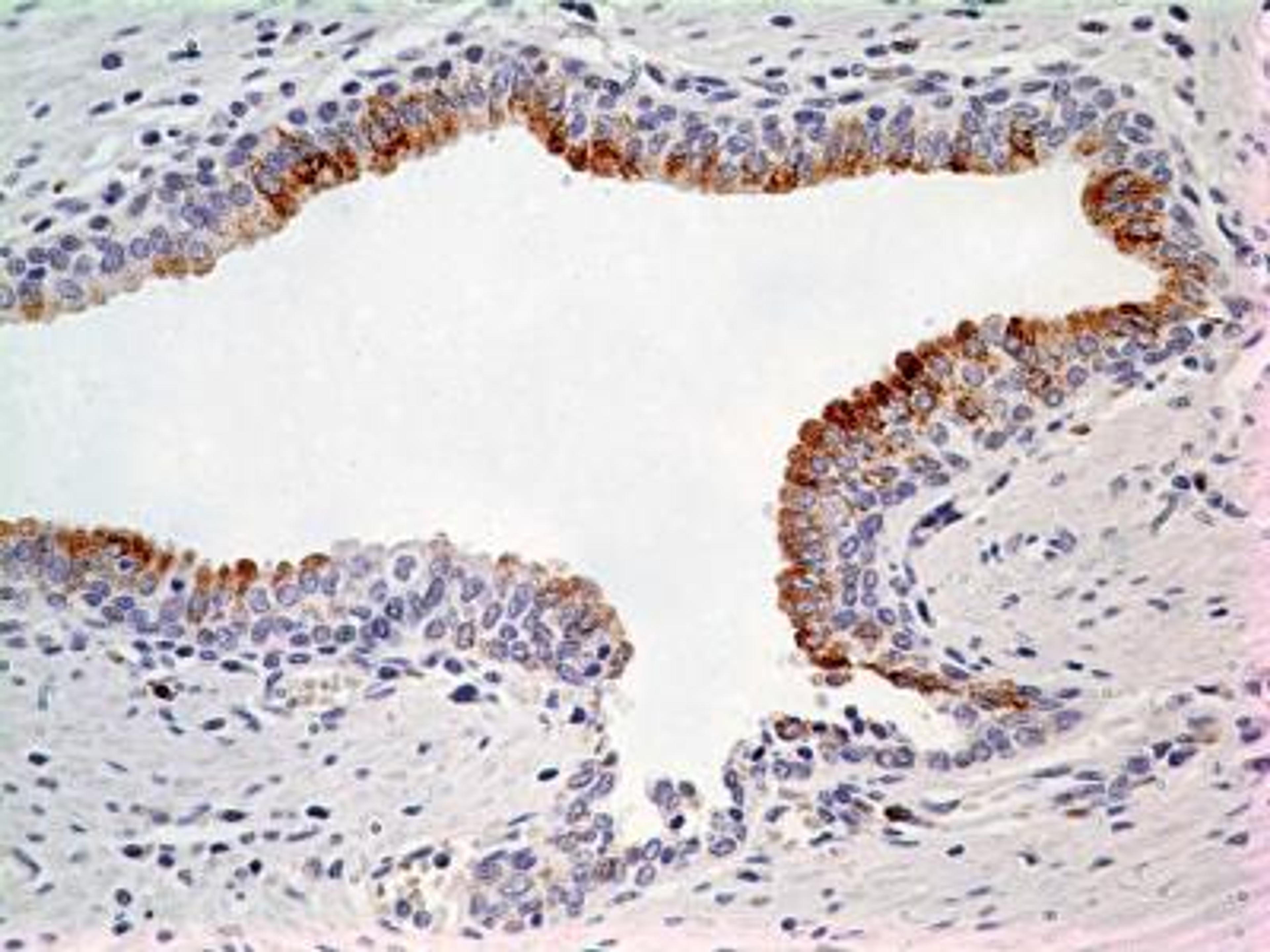 Immunohistochemistry-Paraffin: LIF Antibody (39N7D10) [NBP2-27406] - IHC analysis of formalin-fixed paraffin-embedded tissue section of normal human prostate using 5 ug/ml concentration of LIF antibody (clone 39N7D10). Cell surface/membrane- cytoplasmic immunepositivity  of LIF was observed specifically in the epithelial cells of prostate alveolar glands whereas the surrounding fibromuscular stroma cells did not develop any staining.