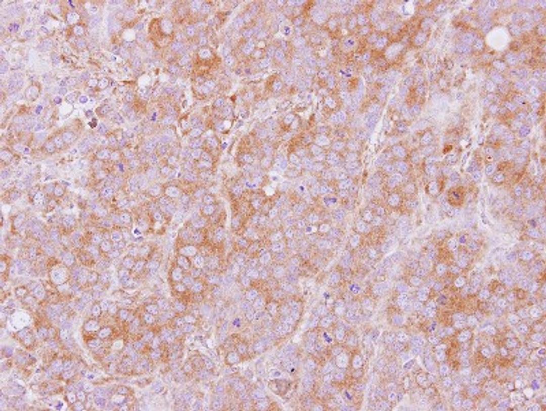 Immunohistochemistry-Paraffin: LMAN2 Antibody [NBP2-17153] - Immunohistochemical analysis of paraffin-embedded MCF7 xenograft, using antibody at 1:100 dilution.