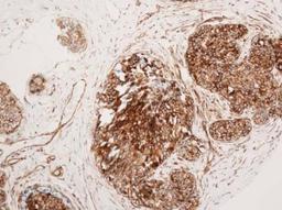 Immunohistochemistry: VCAM-1/CD106 Antibody (6G9) [NBP1-47491] - Breast carcinoma, cytoplasmic staining. Image from verified customer review.