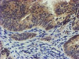 Immunohistochemistry-Paraffin: TIGD1 Antibody (4G9) [NBP2-03877] - Staining of paraffin-embedded Adenocarcinoma of Human endometrium tissue using anti-TIGD1 mouse monoclonal antibody.