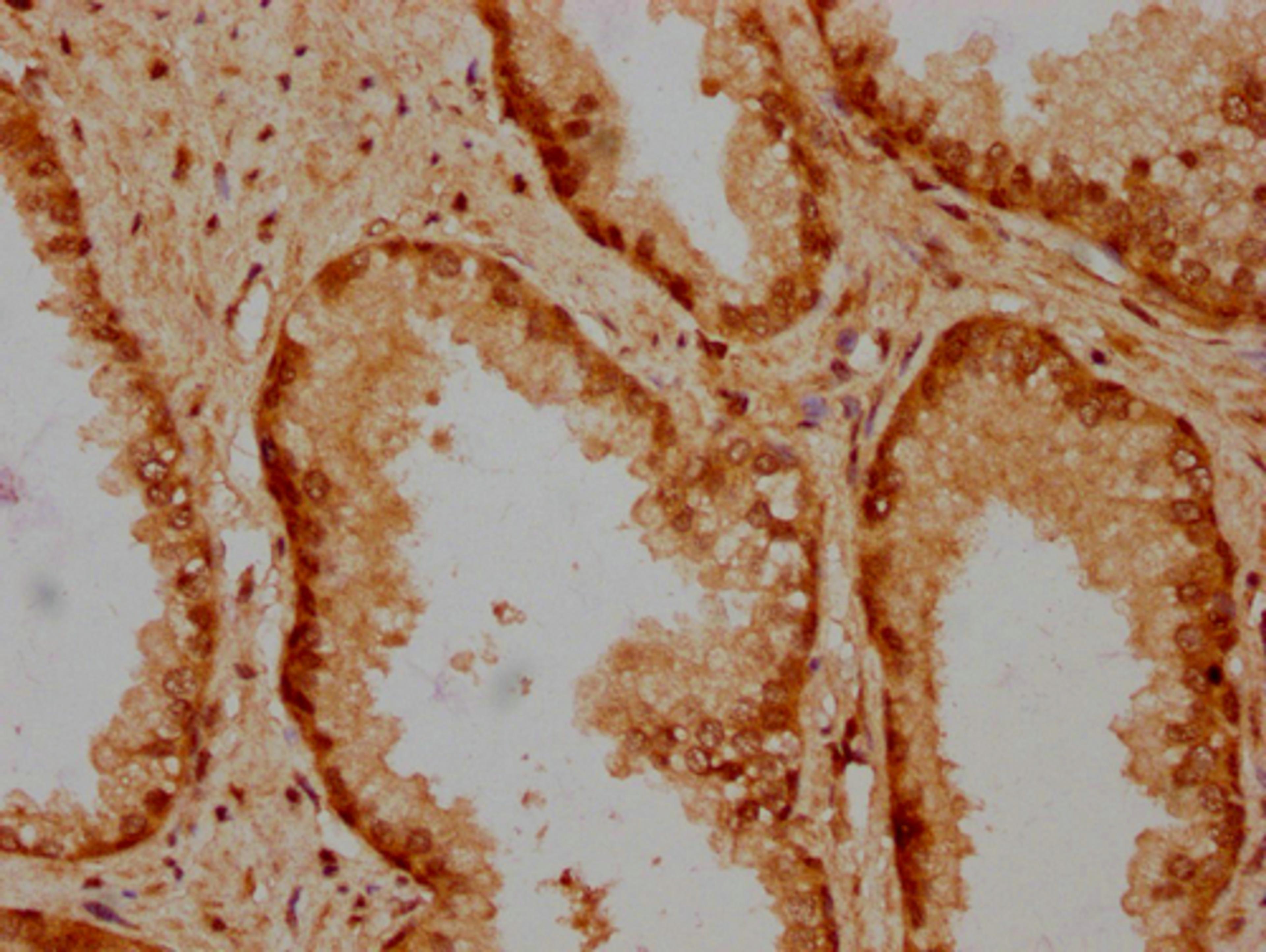IHC image of CSB-PA010429PA31nbutHU diluted at 1:20 and staining in paraffin-embedded human prostate cancer performed on a Leica BondTM system. After dewaxing and hydration, antigen retrieval was mediated by high pressure in a citrate buffer (pH 6.0). Section was blocked with 10% normal goat serum 30min at RT. Then primary antibody (1% BSA) was incubated at 4°C overnight. The primary is detected by a biotinylated secondary antibody and visualized using an HRP conjugated SP system.