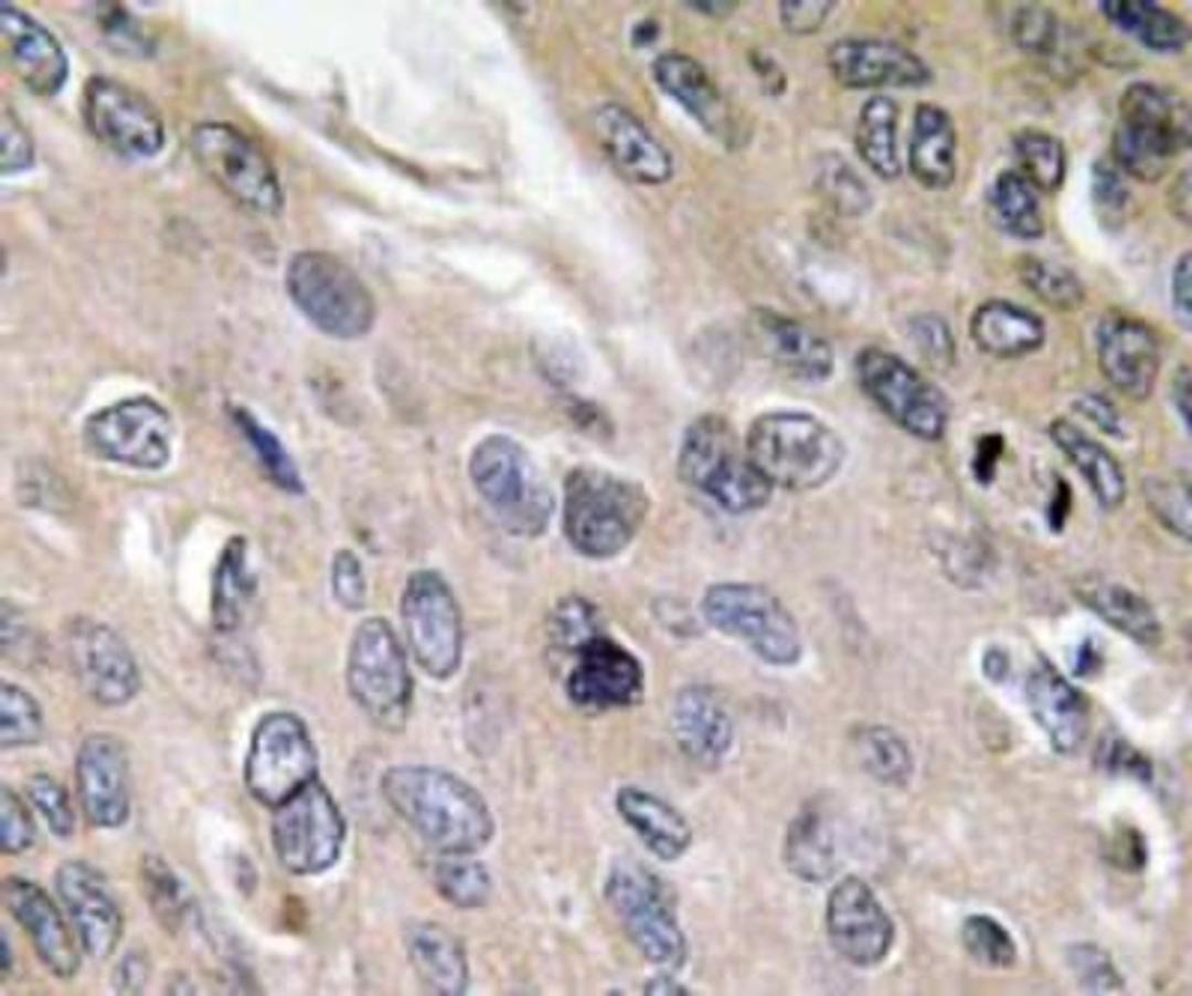 Immunohistochemistry: BMP-6 Antibody [NBP1-19733] - Human lung carcinoma tissue.