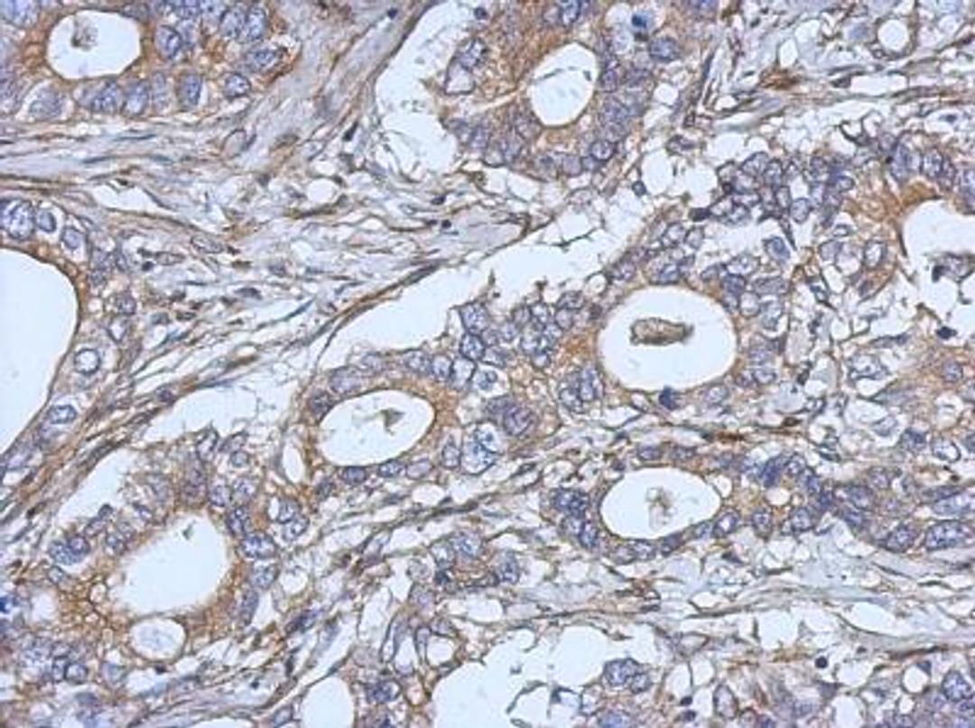 Immunohistochemistry-Paraffin: IL-2 Antibody [NBP2-16948] - Immunohistochemical analysis of paraffin-embedded Gastric ca, using antibody at 1:500 dilution.