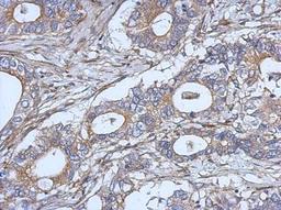 Immunohistochemistry-Paraffin: IL-2 Antibody [NBP2-16948] - Immunohistochemical analysis of paraffin-embedded Gastric ca, using antibody at 1:500 dilution.