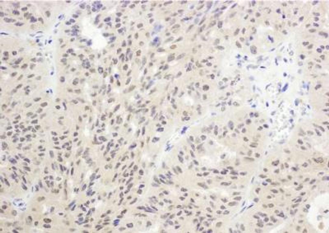 Immunohistochemistry-Paraffin: FoxO1/FKHR Antibody [NB100-2312] - Sample: FFPE section of human ovarian carcinoma. Antibody: Affinity purified rabbit anti-FOXO1a used at a dilution of 1:500 (2ug/ml). Detection: DAB.