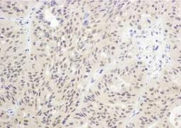 Immunohistochemistry-Paraffin: FoxO1/FKHR Antibody [NB100-2312] - Sample: FFPE section of human ovarian carcinoma. Antibody: Affinity purified rabbit anti-FOXO1a used at a dilution of 1:500 (2ug/ml). Detection: DAB.