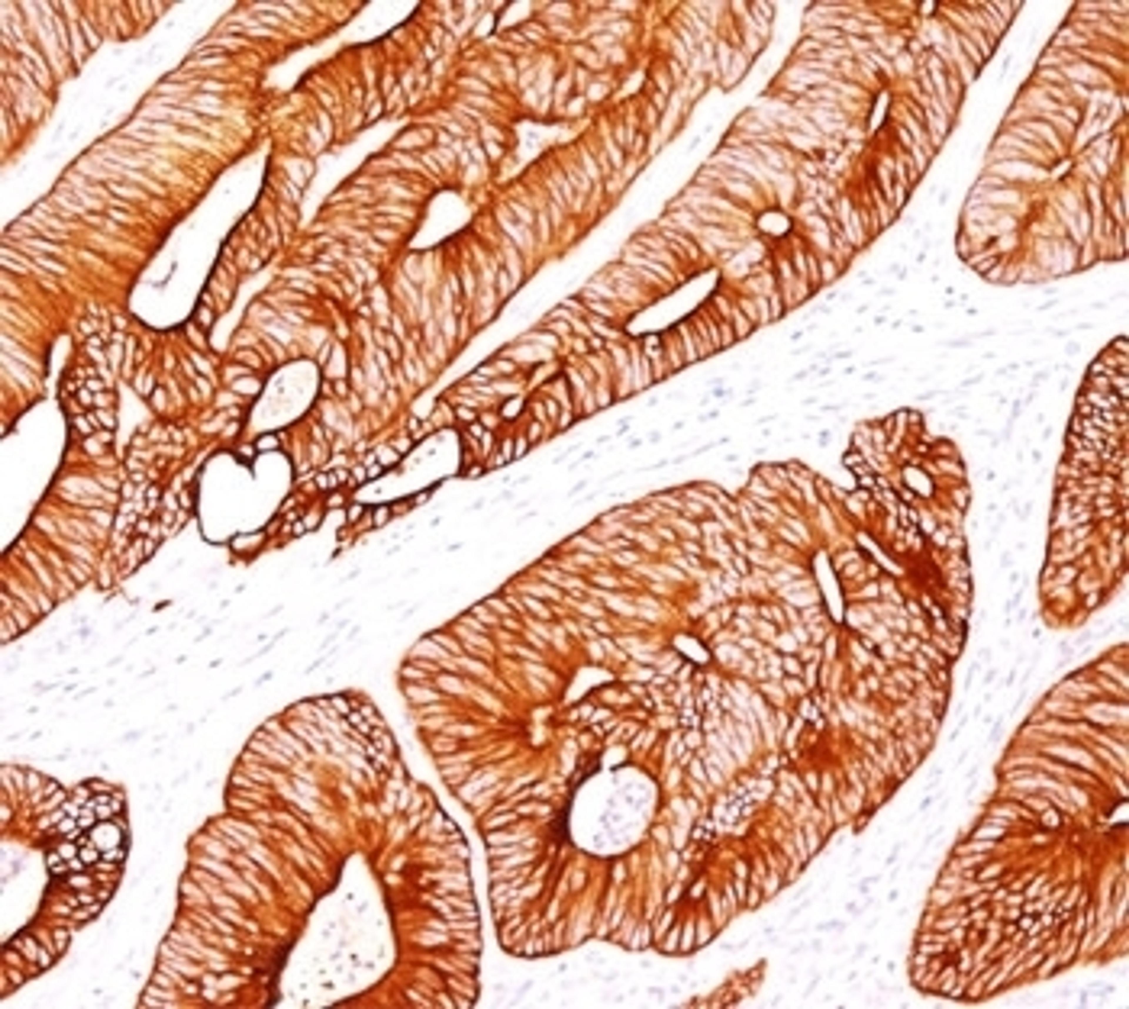 IHC testing of human colon carcinoma stained with Cytokeratin 8 antibody (K8/383).