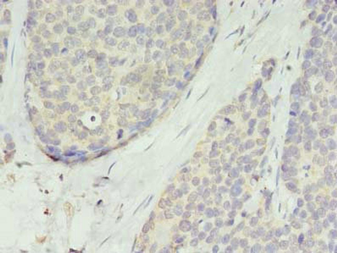 Immunohistochemistry of paraffin-embedded human gastric cancer using CSB-PA023842LA01HU at dilution of 1:100