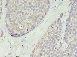 Immunohistochemistry of paraffin-embedded human gastric cancer using CSB-PA023842LA01HU at dilution of 1:100
