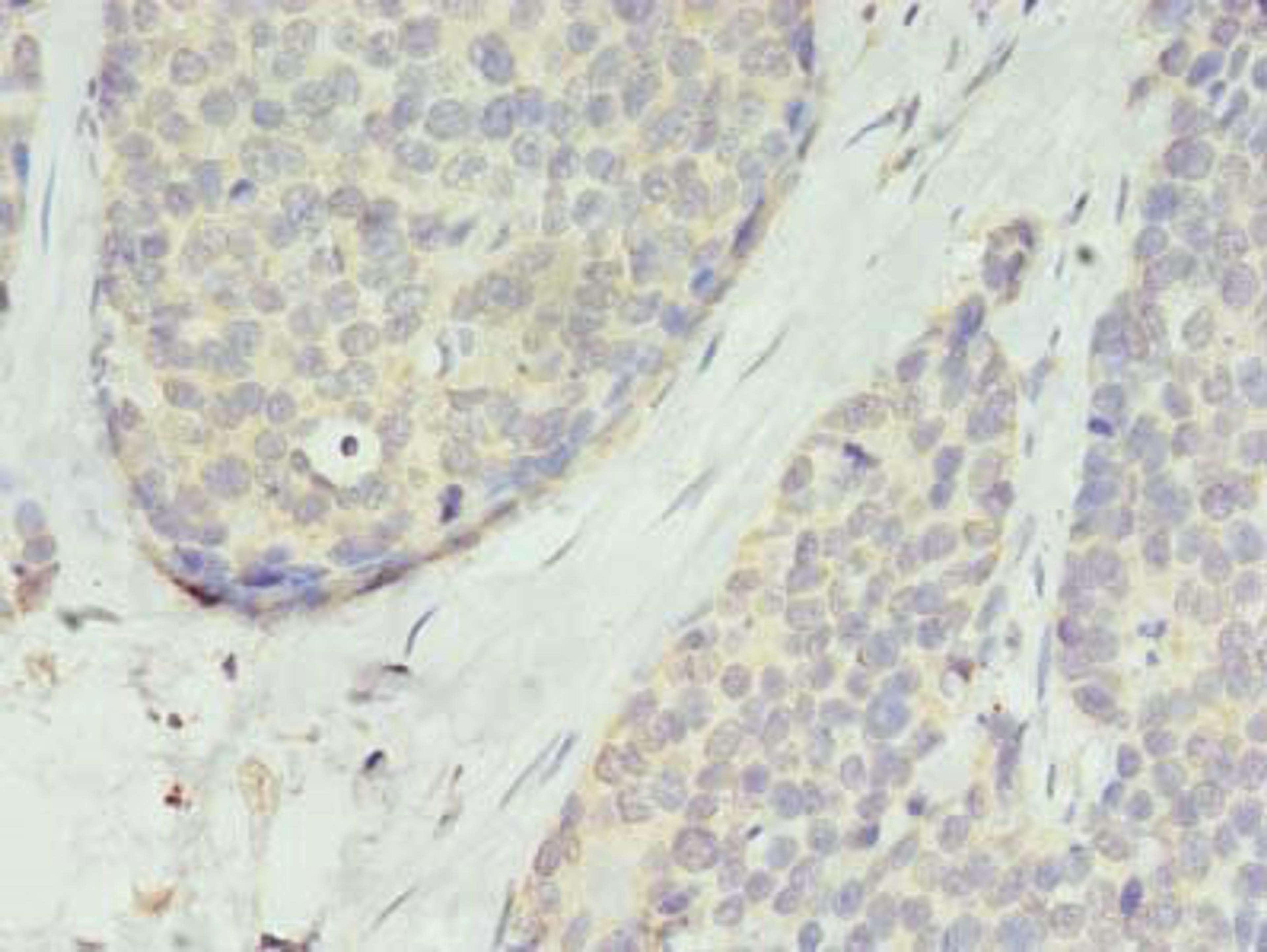 Immunohistochemistry of paraffin-embedded human gastric cancer using CSB-PA023842LA01HU at dilution of 1:100