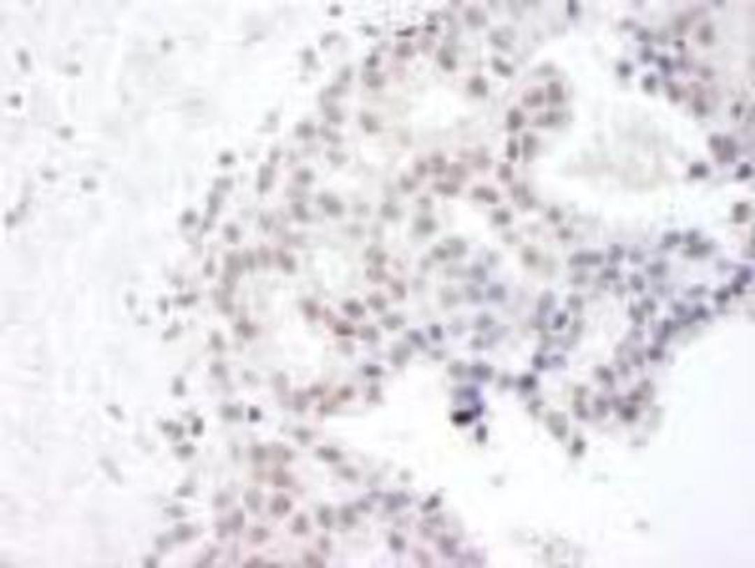 Immunohistochemistry-Paraffin: Gemin 4 Antibody [NB110-40591] - FFPE section of human breast carcinoma.  Affinity purified rabbit anti-Gemin4 used at a dilution of 1:250.