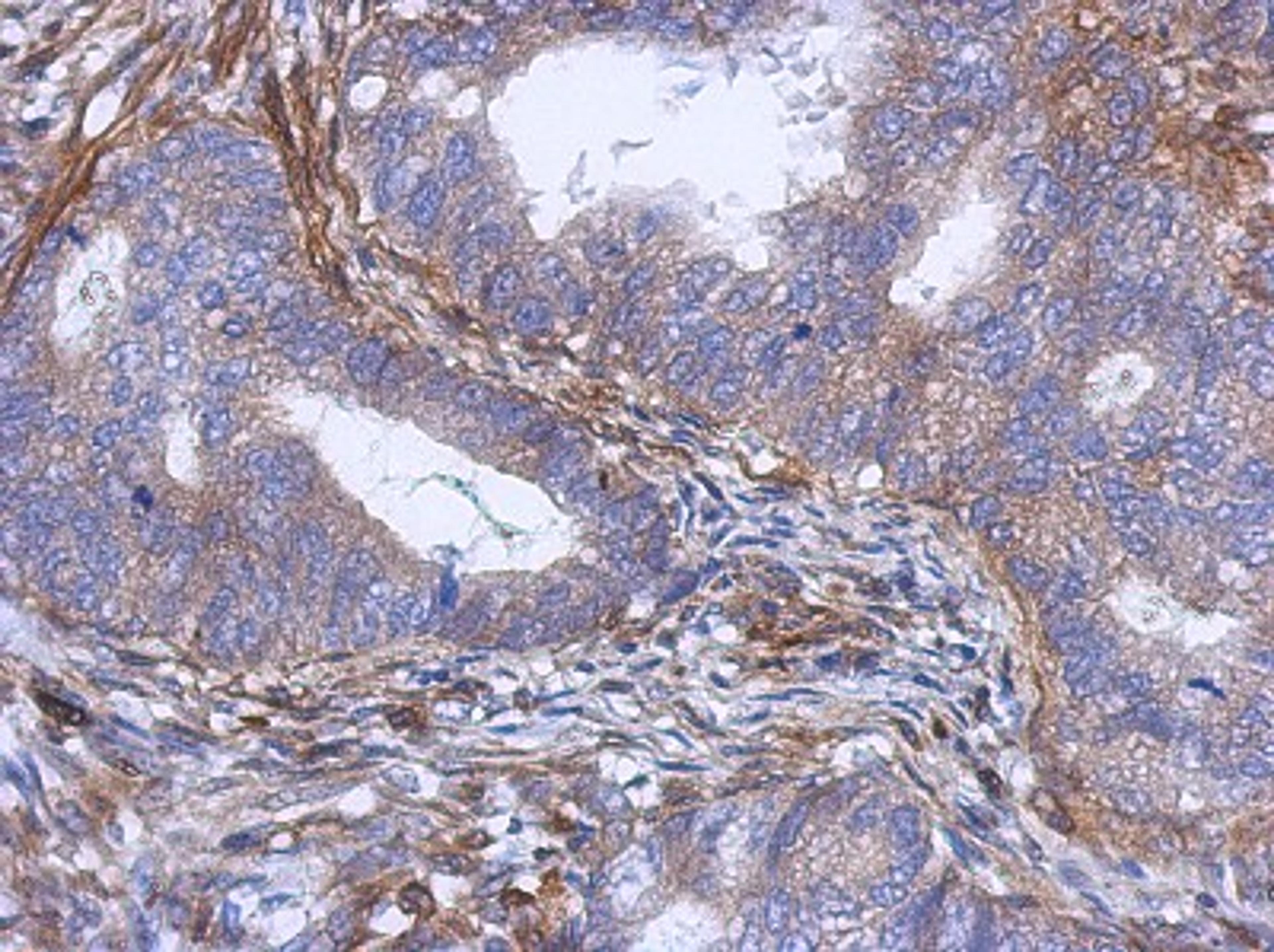 Immunohistochemistry-Paraffin: PABPC5 Antibody [NBP2-19672] - Immunohistochemical analysis of paraffin-embedded Gastric ca, using antibody at 1:500 dilution.