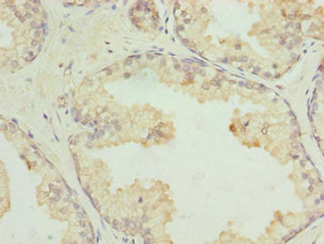 Immunohistochemistry of paraffin-embedded human prostate cancer using CSB-PA860348LA01HU at dilution of 1:100