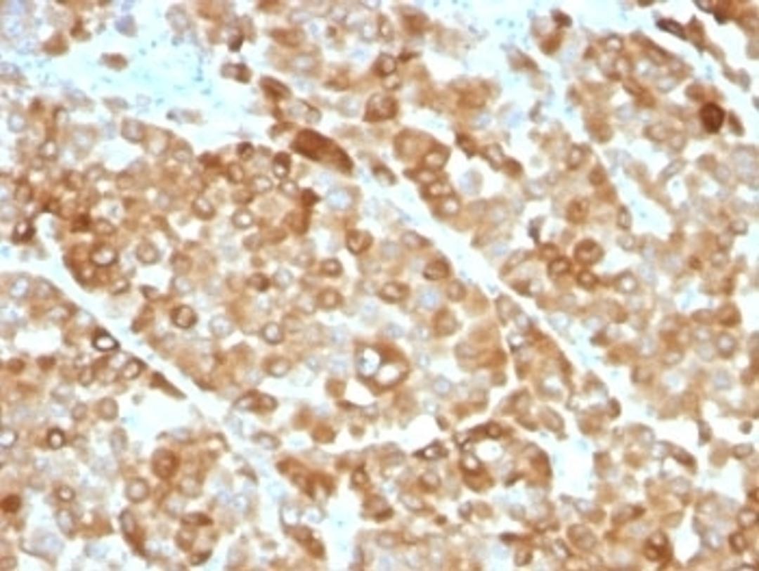 Formalin-fixed, paraffin-embedded melanoma stained with Tyrosinase antibody (OCA1/812).