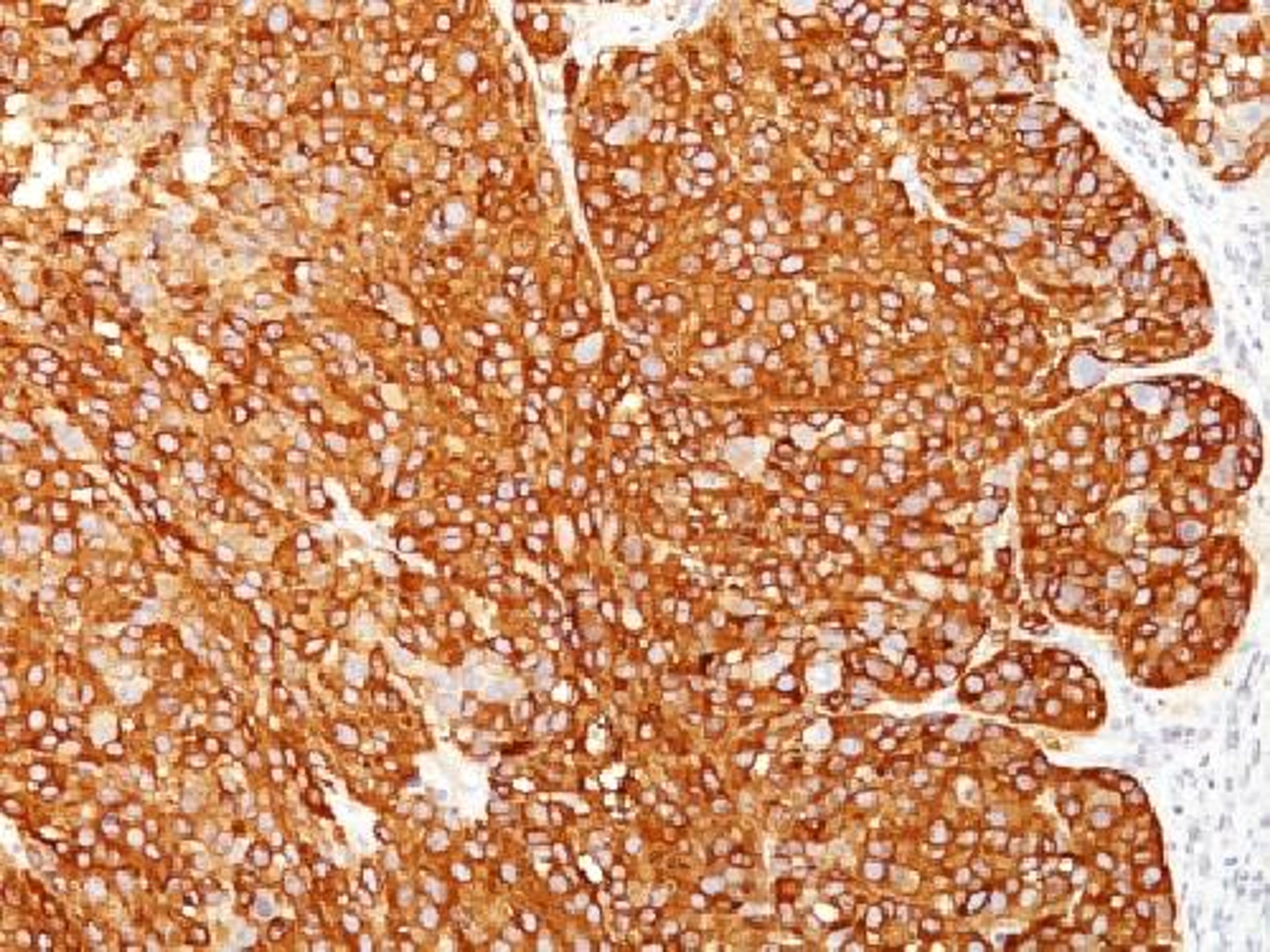 Immunohistochemical staining of human Melanoma tissue using Melanoma Marker antibody