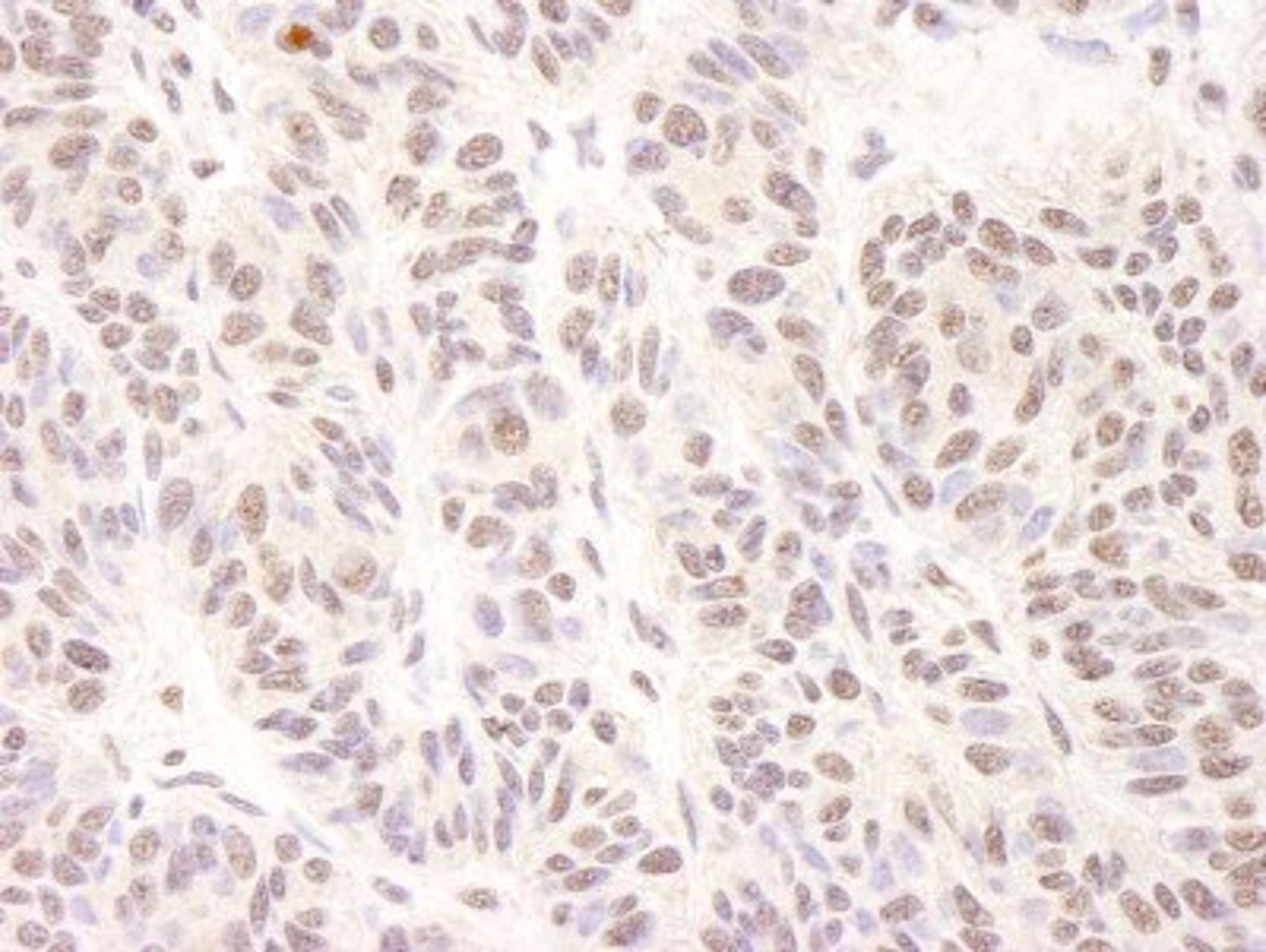 Immunohistochemistry-Paraffin: BTF Antibody [NB100-1704] - Human skin carcinoma.  Antibody used at a dilution of 1:1,000 (0.2ug/ml).