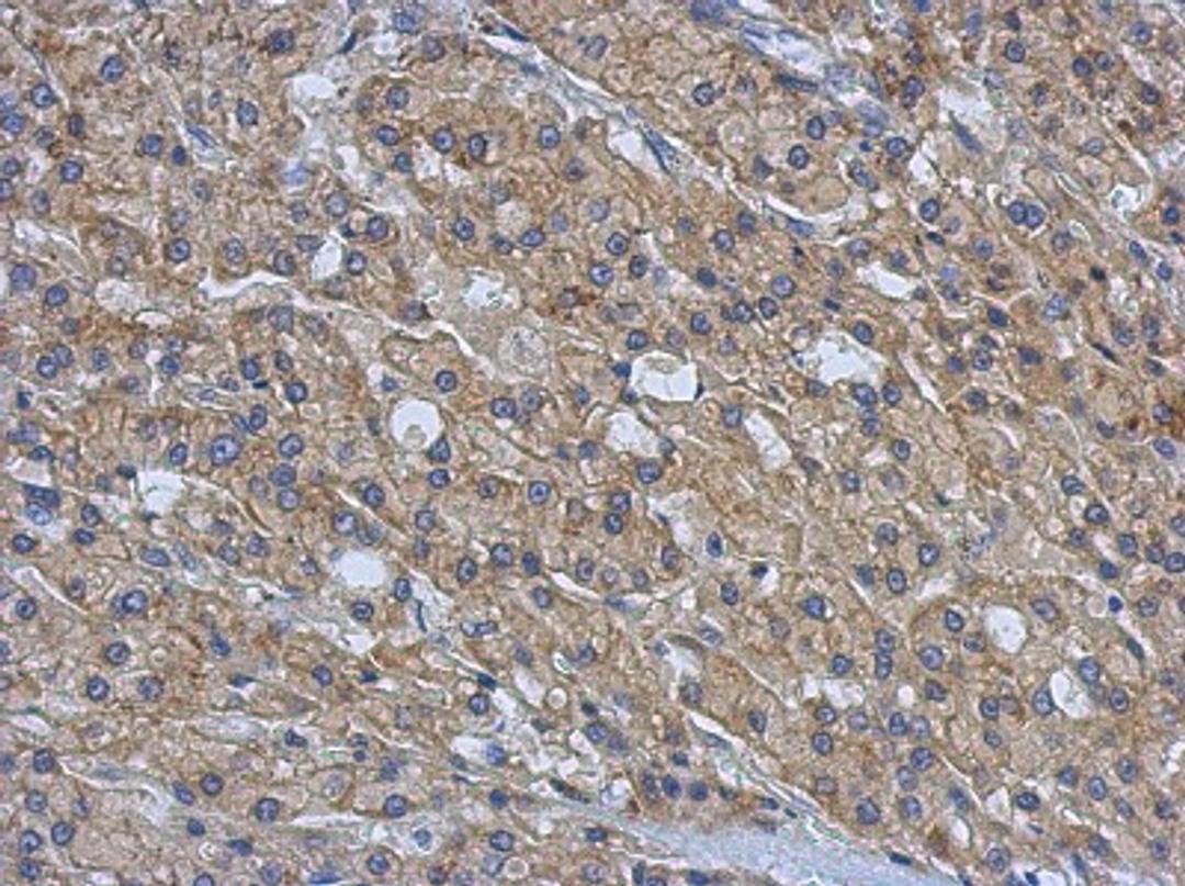 Immunohistochemistry-Paraffin: AMFR Antibody [NBP2-15374] - Paraffin-embedded Hepatoma, using antibody at 1:500 dilution.