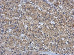 Immunohistochemistry-Paraffin: AMFR Antibody [NBP2-15374] - Paraffin-embedded Hepatoma, using antibody at 1:500 dilution.