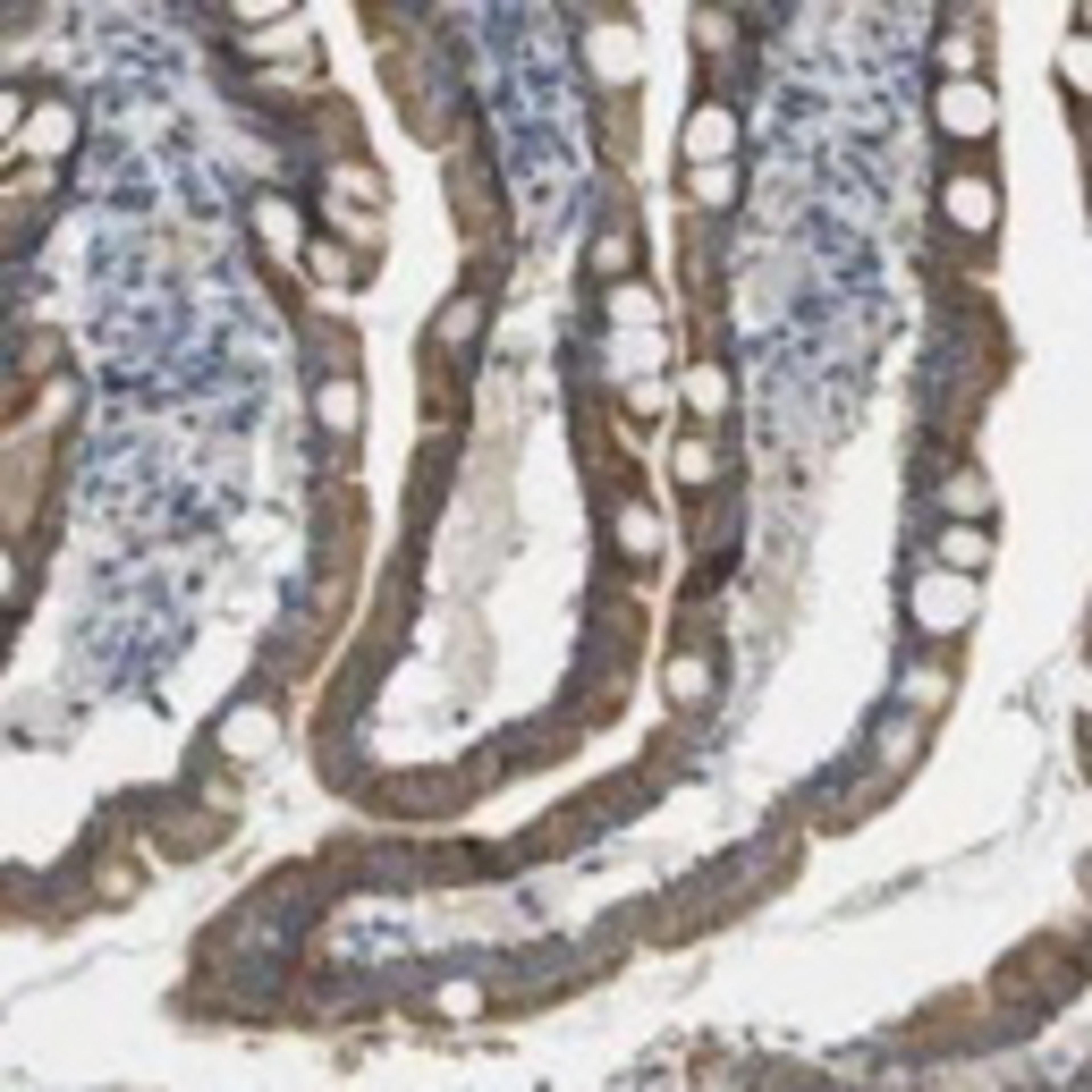 Immunohistochemistry: KRT23 Antibody [22460002] - Normal glandular cells showed moderate cytoplasmic immunoreactivity while most other cell types were weakly stained or negative. Exocrine pancreas, placental trophoblasts, adrenal cortical cells and Leydig cells in testis revealed strong positivity. A majority of malignant cells displayed moderate cytoplasmic immunoreactivity. Thyroid cancers and few cases of colorectal cancers revealed strong positivity. Most skin cancers, malignant lymphomas and gliomas were negative.  Image and statement courtesy of the Human Protein Atlas (HPA).  View all of the IHC expression profiles performed by the Human Protein Atlas.