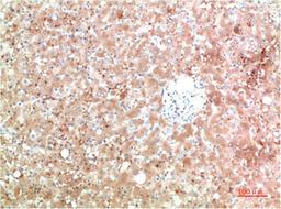Immunohistochemical analysis of paraffin-embedded Human Liver Carcinoma Tissue using TTR Mouse mAb diluted at 1:200.