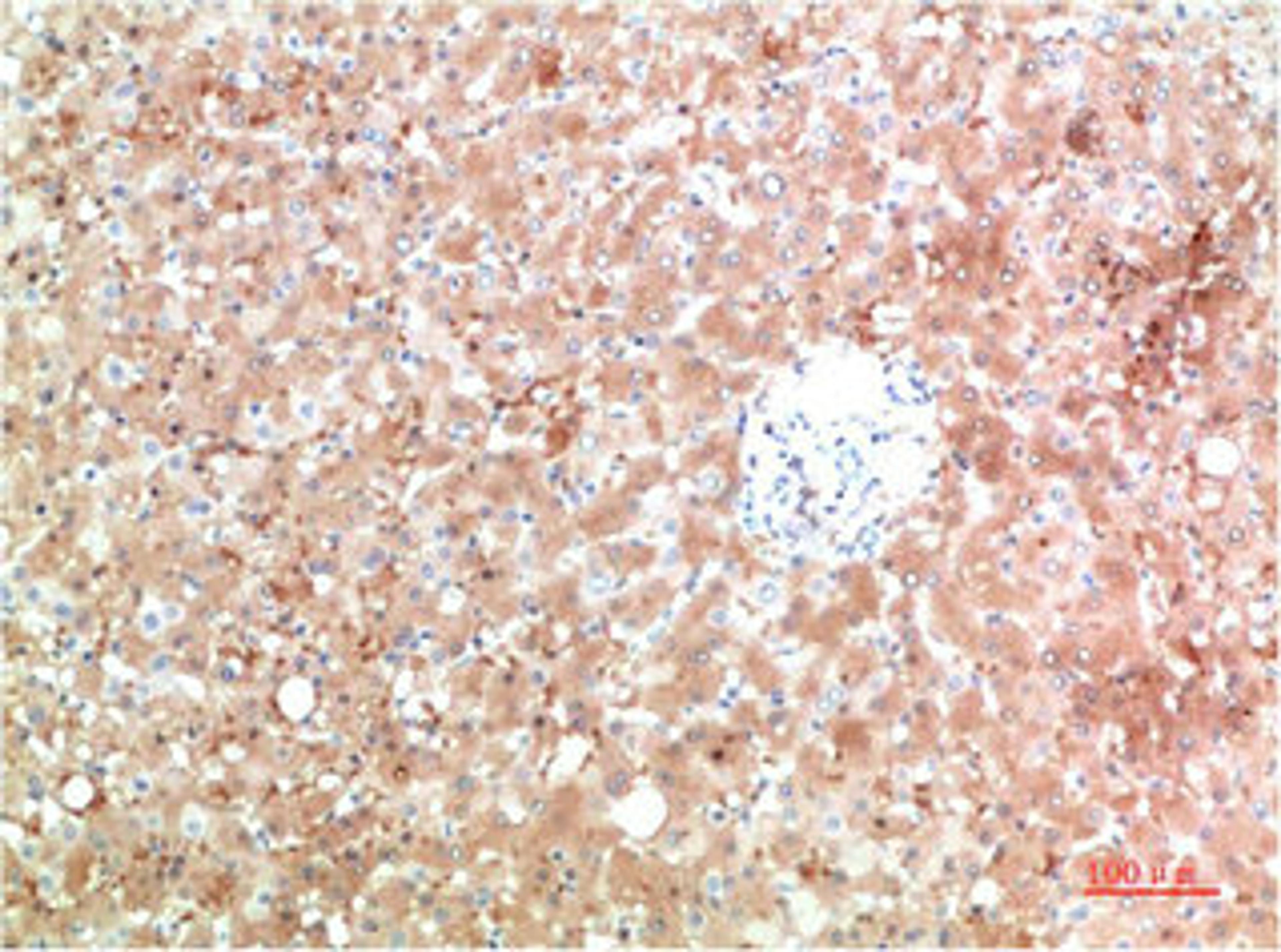 Immunohistochemical analysis of paraffin-embedded Human Liver Carcinoma Tissue using TTR Mouse mAb diluted at 1:200.
