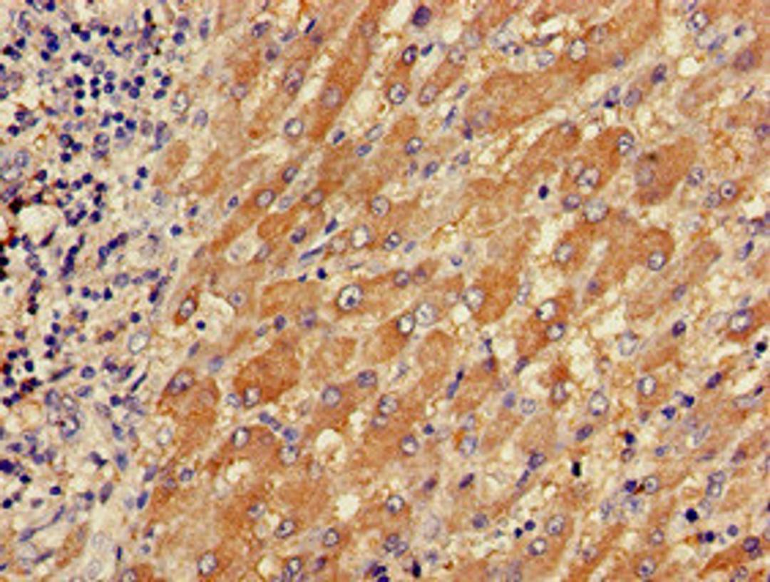 Immunohistochemistry of paraffin-embedded human liver cancer using CSB-PA024106LA01HU at dilution of 1:100