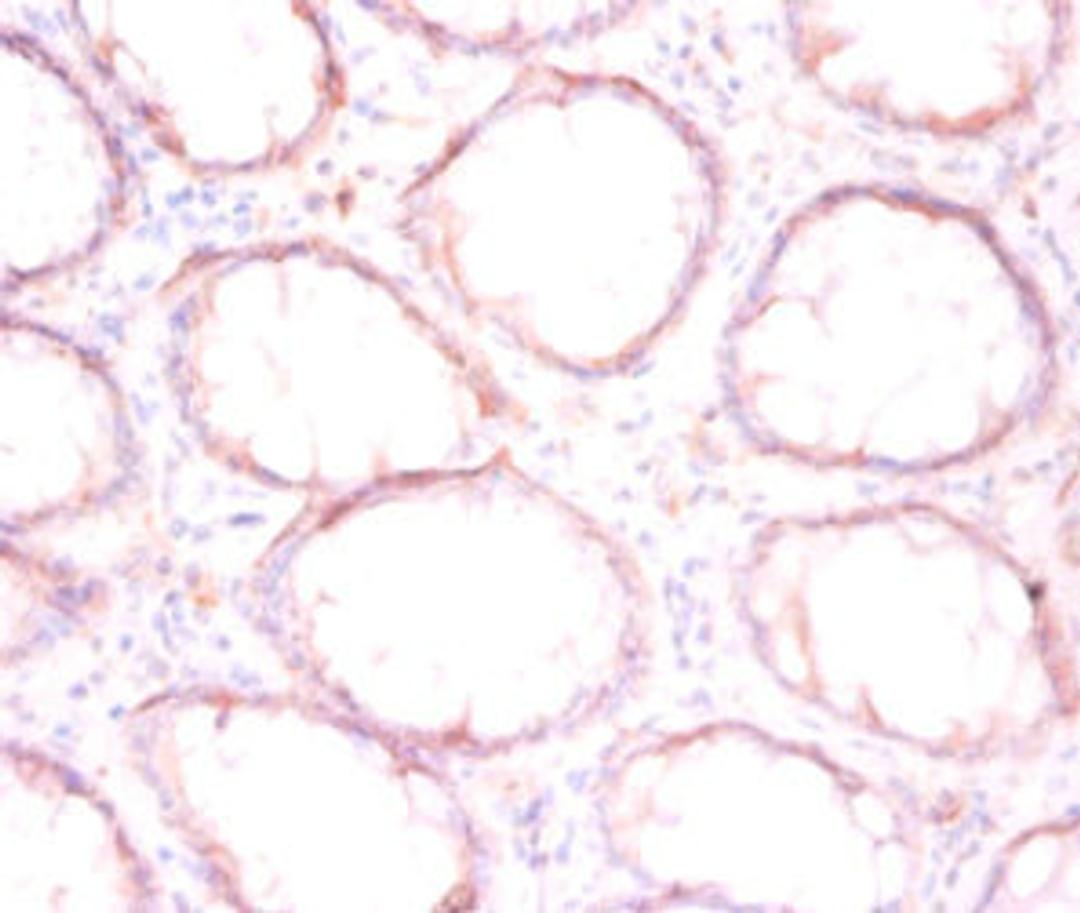 Immunohistochemistry of paraffin-embedded human colon cancer using CSB-PA00254A0Rb at dilution of 1:50