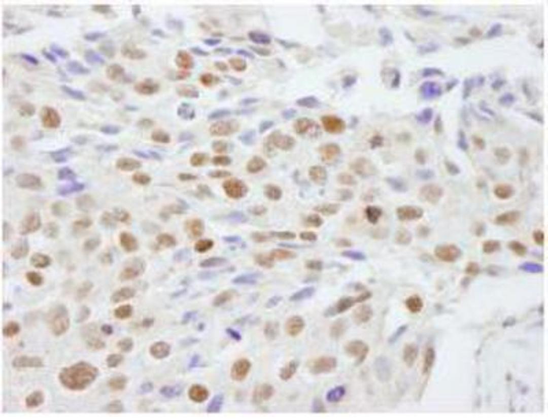 Immunohistochemistry-Paraffin: Scaffold attachment factor B2 Antibody [NB100-58791] - FFPE section of human breast carcinoma.  Affinity purified rabbit anti-SAFB2 used at a dilution of 1:100.