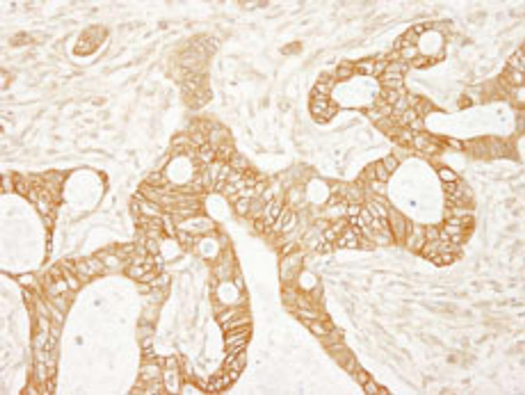 Detection of human beta Catenin by immunohistochemistry.