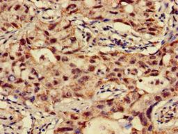 Immunohistochemistry of paraffin-embedded human lung cancer using CSB-PA015464LA01HU at dilution of 1:100