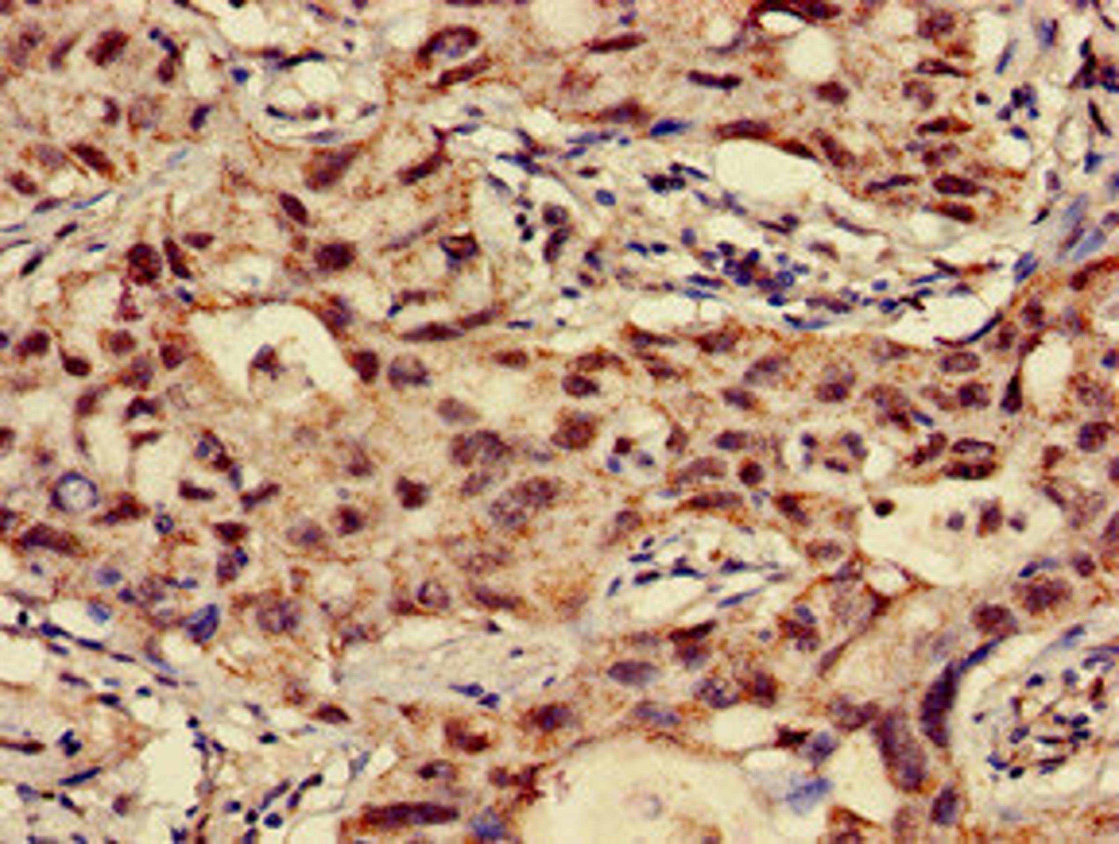 Immunohistochemistry of paraffin-embedded human lung cancer using CSB-PA015464LA01HU at dilution of 1:100