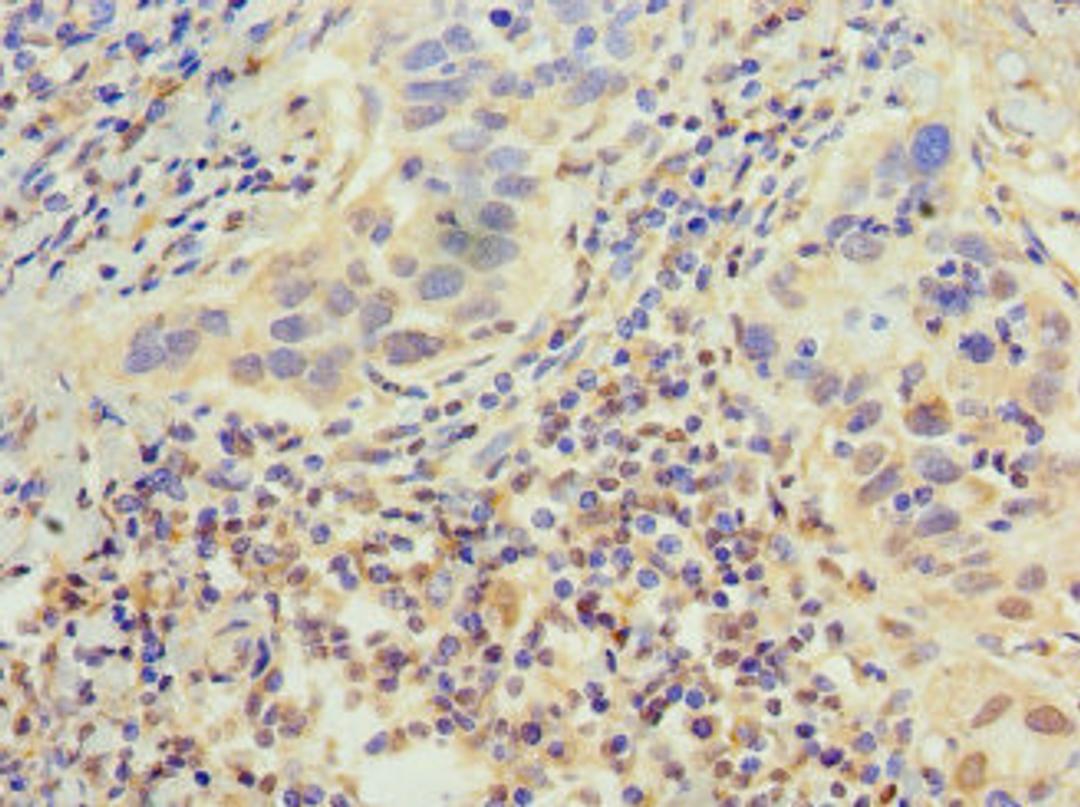 Immunohistochemistry of paraffin-embedded human bladder cancer using CSB-PA007702HA01HU at dilution of 1:100