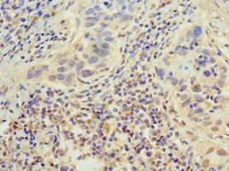 Immunohistochemistry of paraffin-embedded human bladder cancer using CSB-PA007702HA01HU at dilution of 1:100