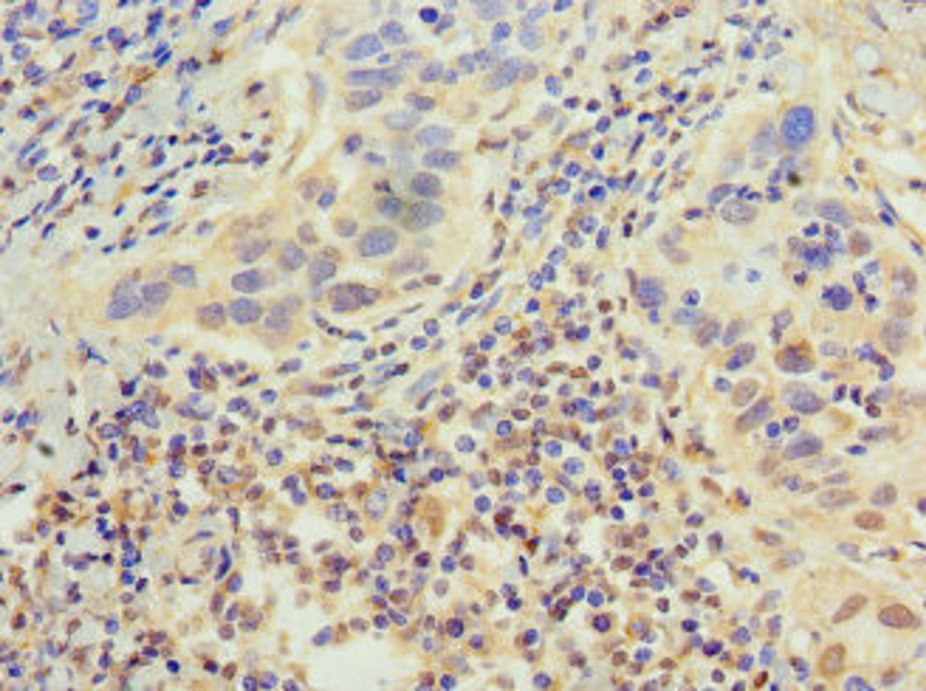 Immunohistochemistry of paraffin-embedded human bladder cancer using CSB-PA007702HA01HU at dilution of 1:100
