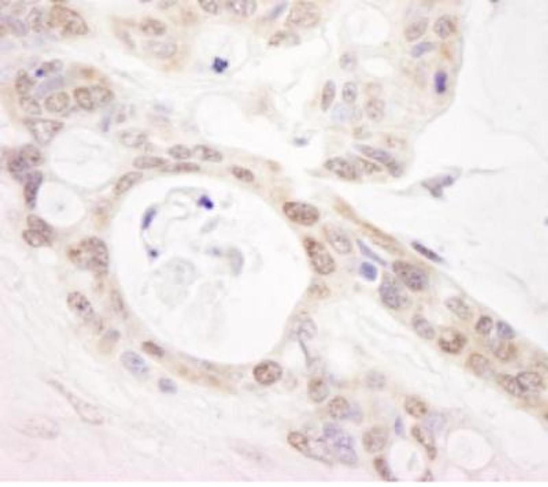 Immunohistochemistry: PUS1 Antibody [NB100-86983] - Section of human ovarian carcinoma. Antibody: Affinity  purified rabbit anti-PUS1 used at a dilution of 1:1,000 (0.2 ug/ml). Detection: DAB