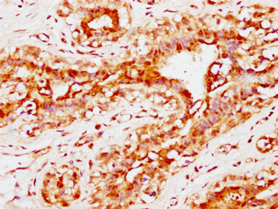 IHC image of CSB-PA004600EA01HU diluted at 1:300 and staining in paraffin-embedded human breast cancer performed on a Leica BondTM system. After dewaxing and hydration, antigen retrieval was mediated by high pressure in a citrate buffer (pH 6.0). Section was blocked with 10% normal goat serum 30min at RT. Then primary antibody (1% BSA) was incubated at 4°C overnight. The primary is detected by a biotinylated secondary antibody and visualized using an HRP conjugated SP system.