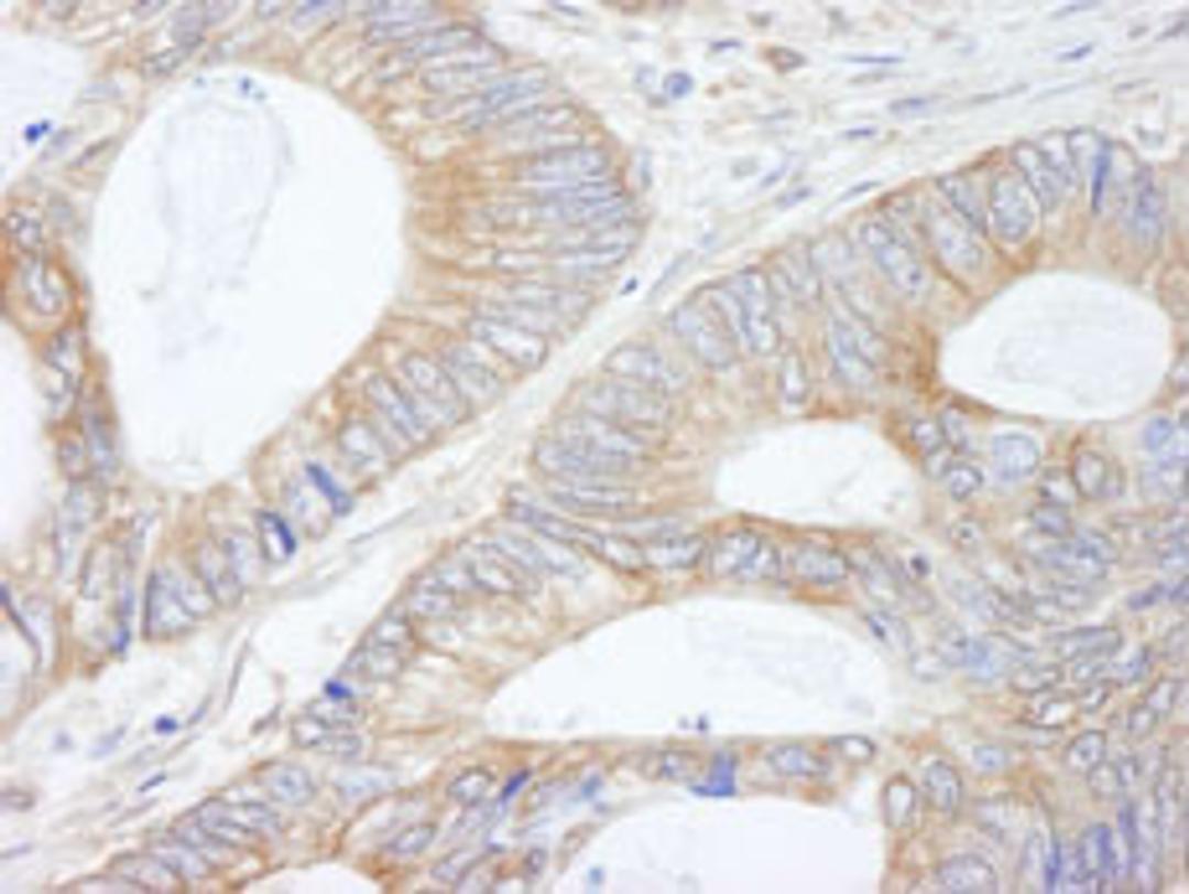 Detection of human CIP2A by immunohistochemistry.