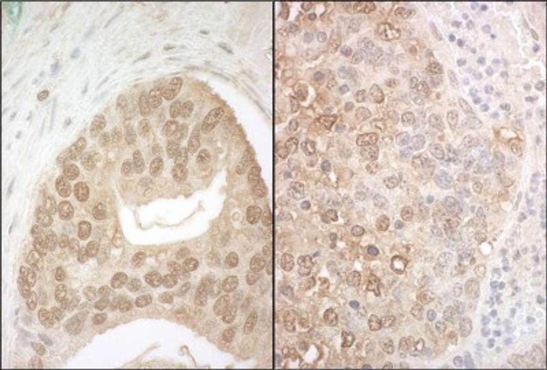 Immunohistochemistry-Paraffin: Apc7 Antibody [NBP1-40367] - Human prostate carcinoma (left) and mouse teratoma (right). Antibody used at a dilution of 1:200 (1ug/ml).