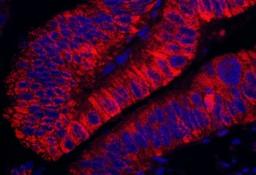 Immunocytochemistry/Immunofluorescence: ARHGEF5 Antibody [NBP1-23000] - Human colon carcinoma. Antibody used at a dilution of 1:200 (1ug/ml).