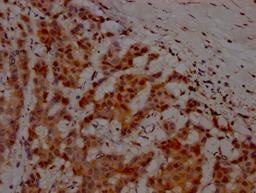 IHC image of CSB-RA166706A0HU diluted at 1:100 and staining in paraffin-embedded human breast cancer performed on a Leica BondTM system. After dewaxing and hydration, antigen retrieval was mediated by high pressure in a citrate buffer (pH 6.0). Section was blocked with 10% normal goat serum 30min at RT. Then primary antibody (1% BSA) was incubated at 4℃ overnight. The primary is detected by a Goat anti-rabbit IgG polymer labeled by HRP and visualized using 0.05% DAB.