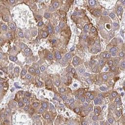 Immunohistochemistry-Paraffin: HIVEP2 Antibody [NBP2-33771] - liver cancer