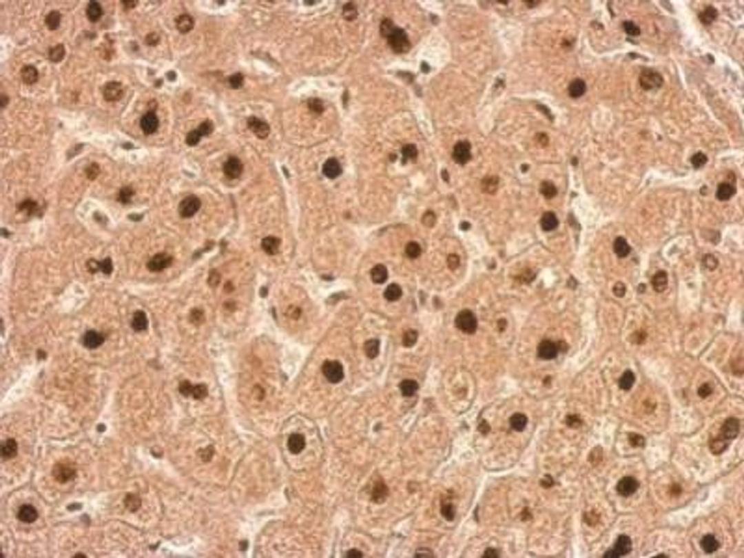 Immunohistochemistry-Paraffin: Transaldolase 1 Antibody [NBP1-32121] - Hepatoma.