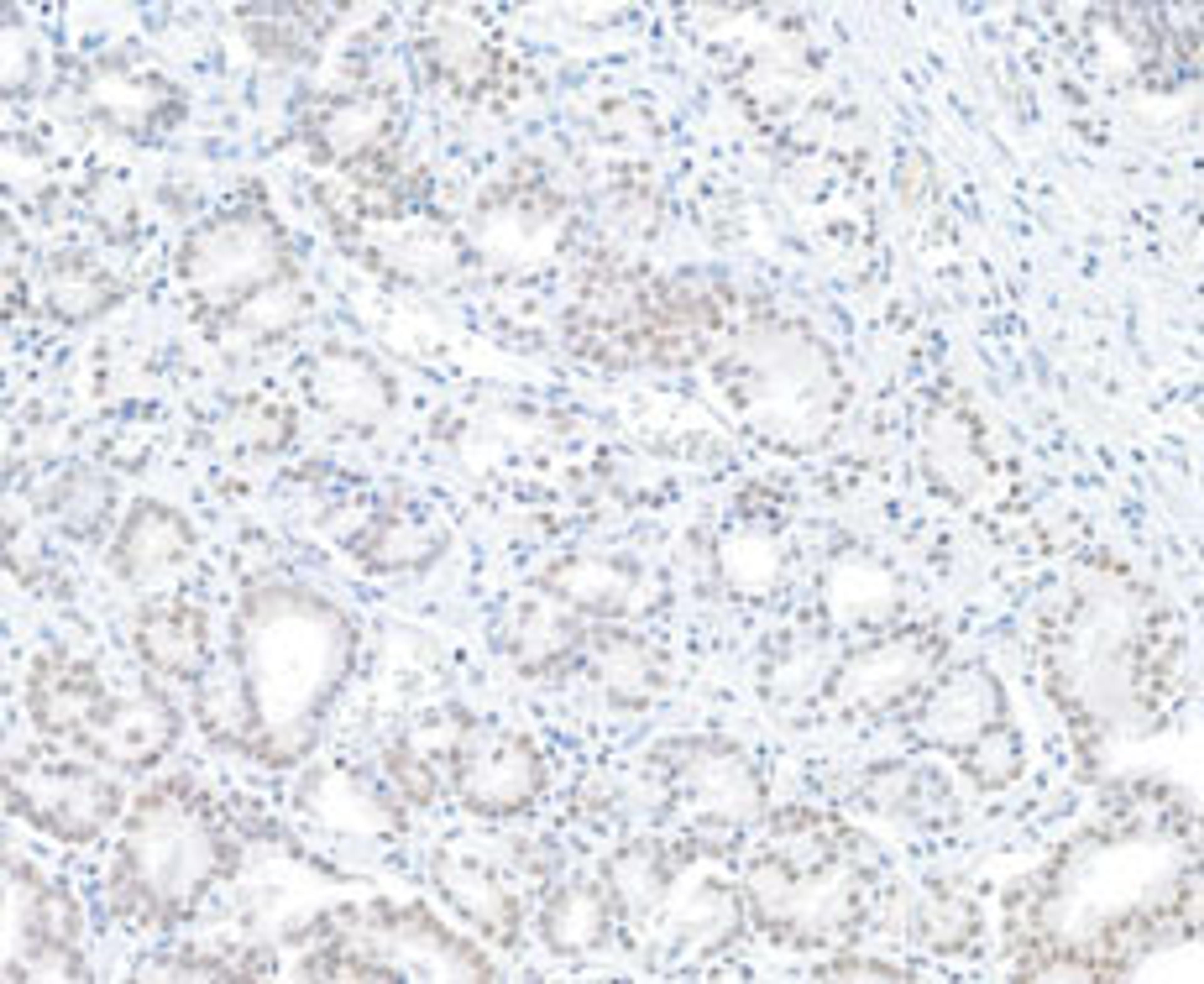 Detection of human BAP1 in FFPE prostate carcinoma by IHC.