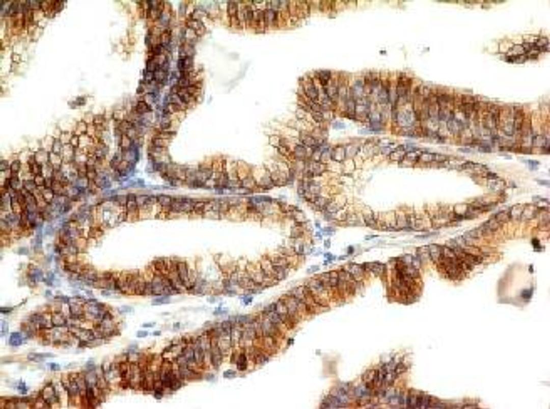 Immunohistochemical staining of human Colon carcinoma tissue using CDH1 antibody