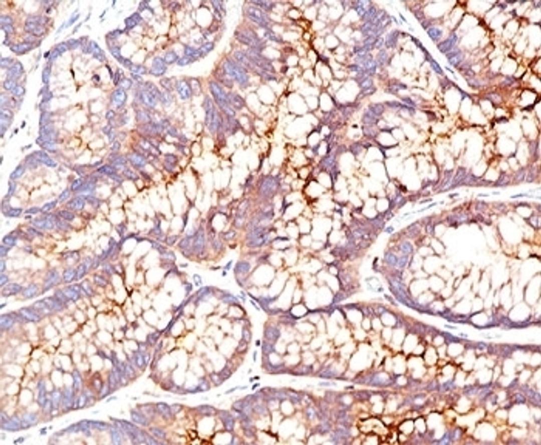 IHC testing of human colon carcinoma stained with CEA antibody (CEA31).