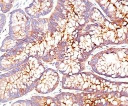 IHC testing of human colon carcinoma stained with CEA antibody (CEA31).