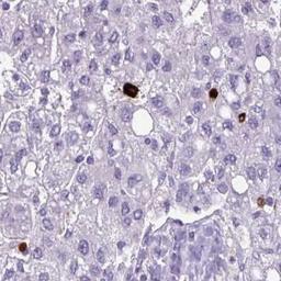 Immunohistochemistry-Paraffin: Cathepsin G Antibody [NBP2-33498] - liver cancer