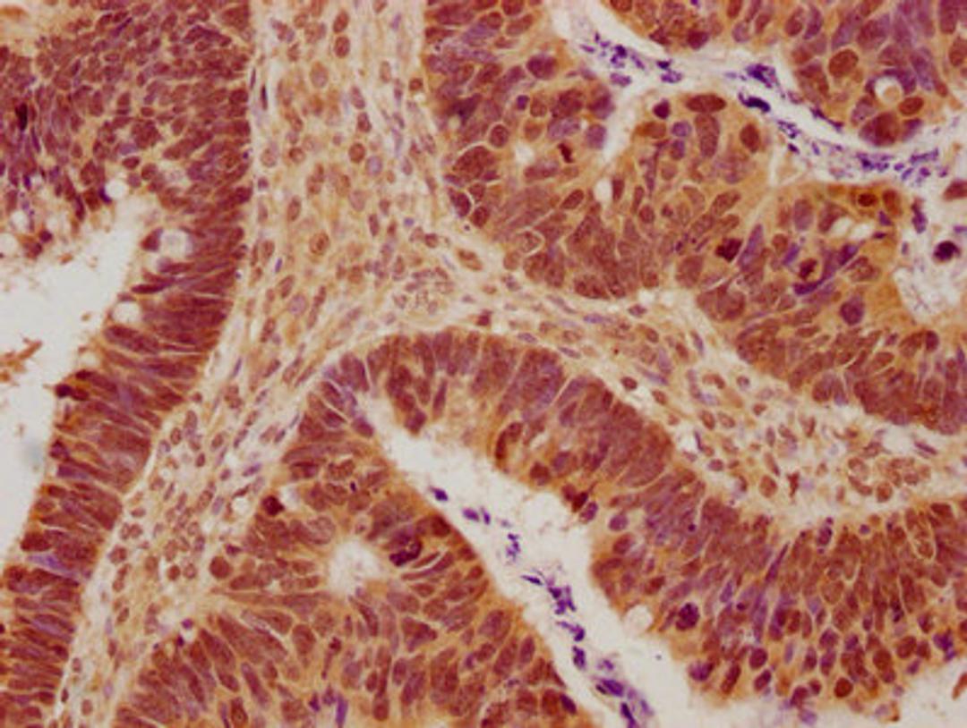 IHC image of CSB-PA880071NA01HU diluted at 1:600 and staining in paraffin-embedded human ovarian cancer performed on a Leica BondTM system. After dewaxing and hydration, antigen retrieval was mediated by high pressure in a citrate buffer (pH 6.0). Section was blocked with 10% normal goat serum 30min at RT. Then primary antibody (1% BSA) was incubated at 4°C overnight. The primary is detected by a biotinylated secondary antibody and visualized using an HRP conjugated SP system.