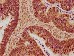 IHC image of CSB-PA880071NA01HU diluted at 1:600 and staining in paraffin-embedded human ovarian cancer performed on a Leica BondTM system. After dewaxing and hydration, antigen retrieval was mediated by high pressure in a citrate buffer (pH 6.0). Section was blocked with 10% normal goat serum 30min at RT. Then primary antibody (1% BSA) was incubated at 4°C overnight. The primary is detected by a biotinylated secondary antibody and visualized using an HRP conjugated SP system.